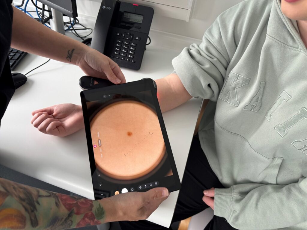 Dermascopy diagnostic test being performed on a mole using a hand held devoice attached to a tablet device